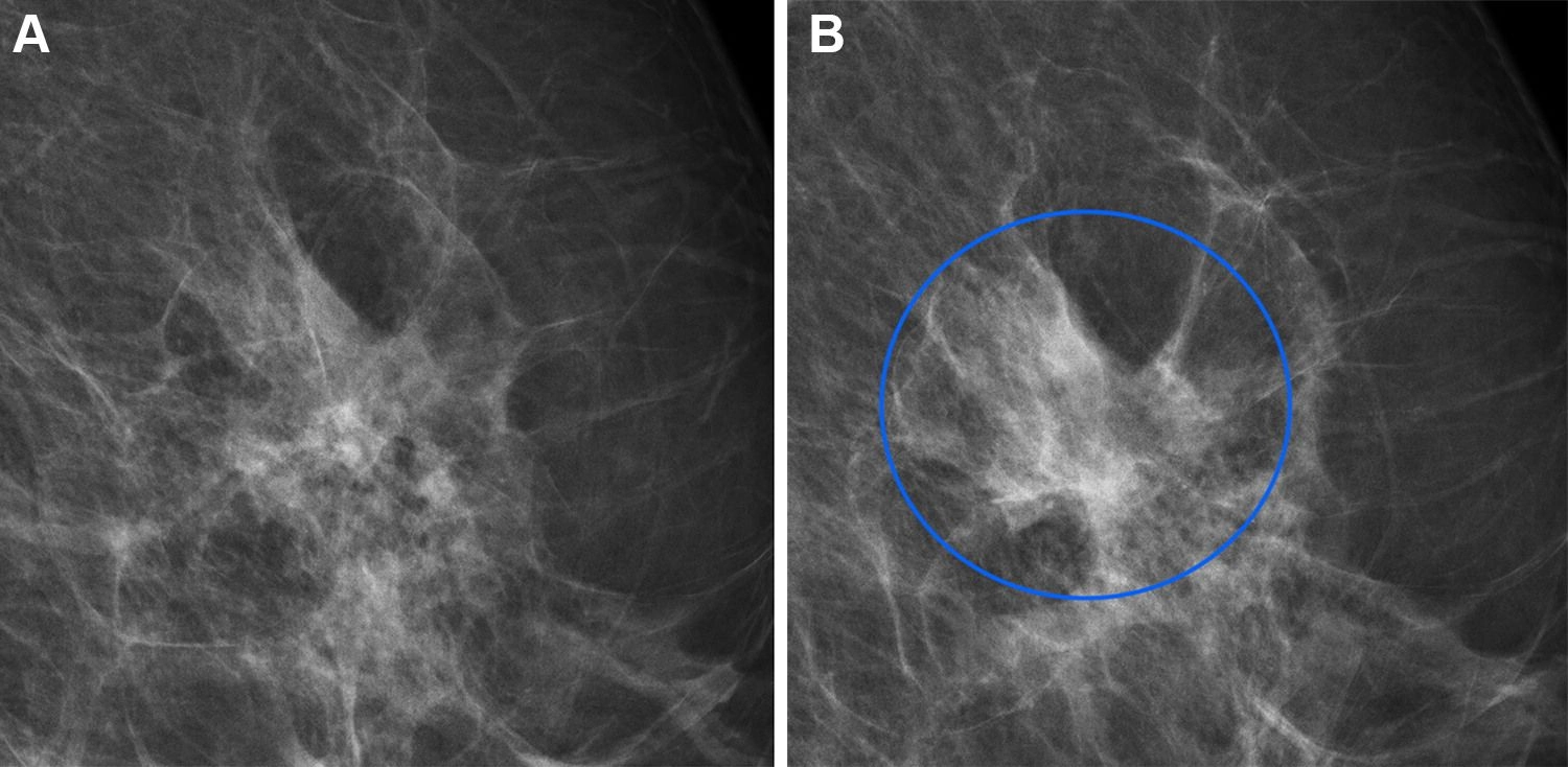 Full-field digital mammograms in a 60-year-old woman with an interval cancer. Source: https://shorturl.at/BUAY8