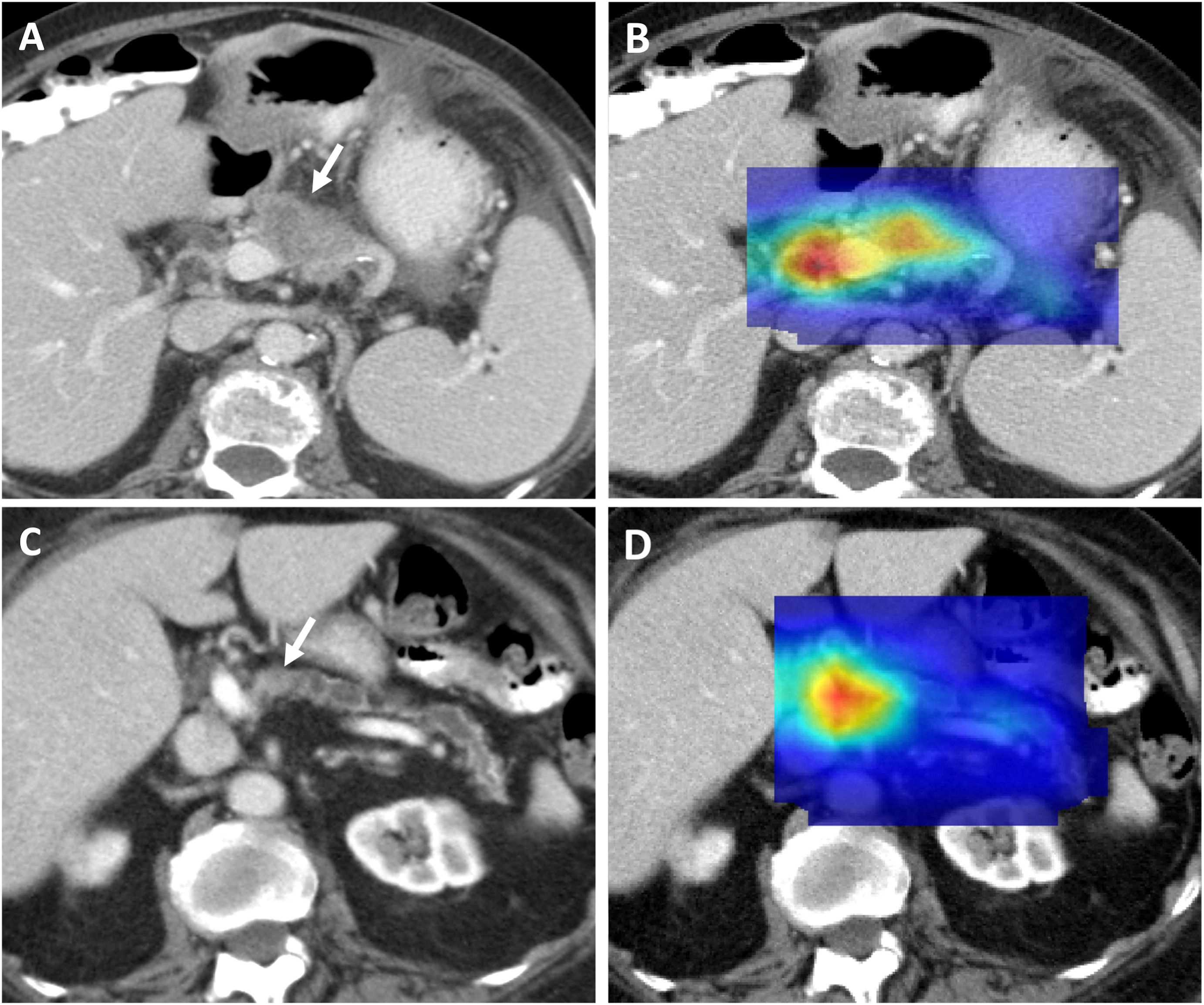  Axial portal-venous phase CT images show correctly classified malignant CTs and their corresponding heat maps. Source: https://shorturl.at/FTeiZ